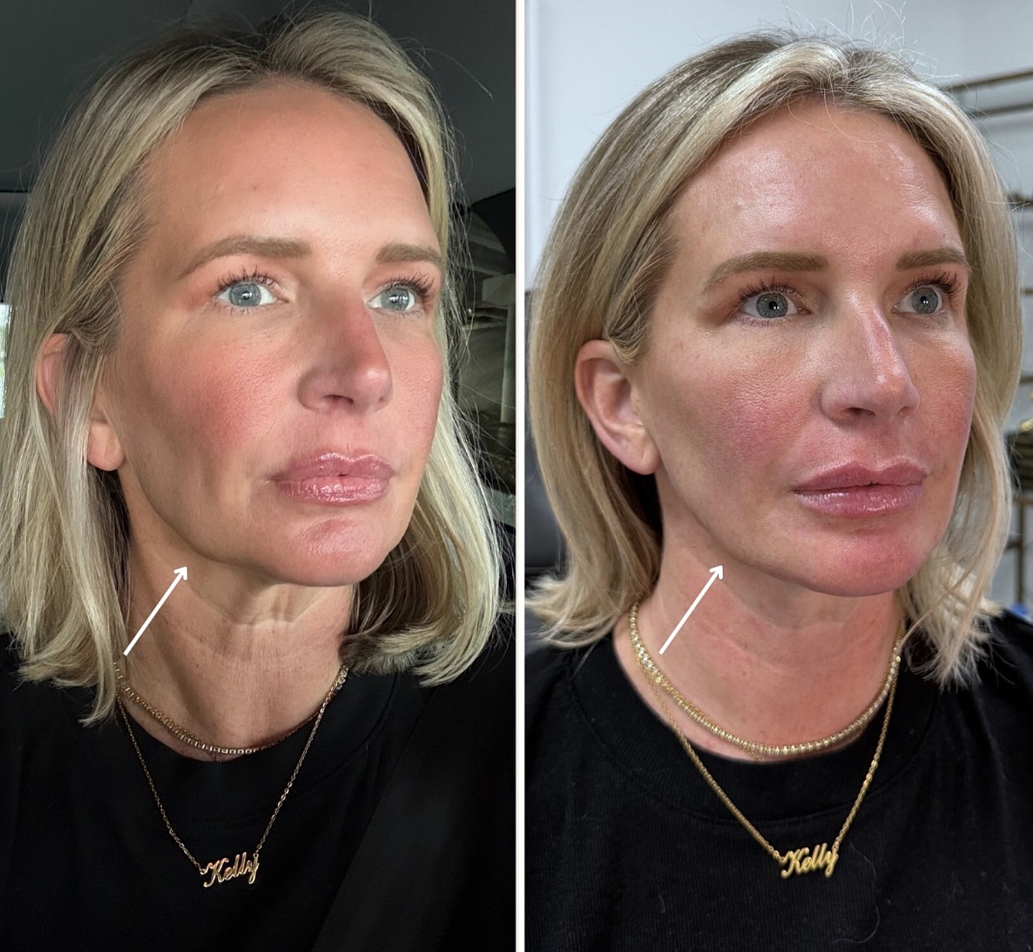 Jawline Filler Gallery Before & After