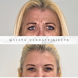 Botox Gallery Before & After