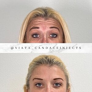 Botox Gallery Before & After