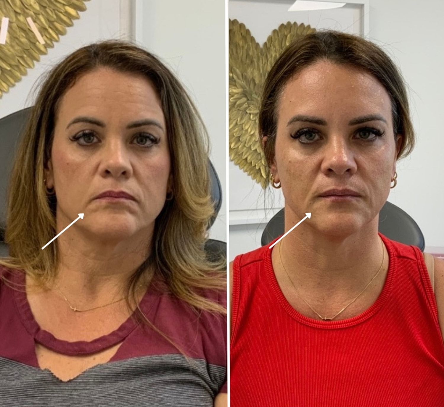Botox Gallery Before & After