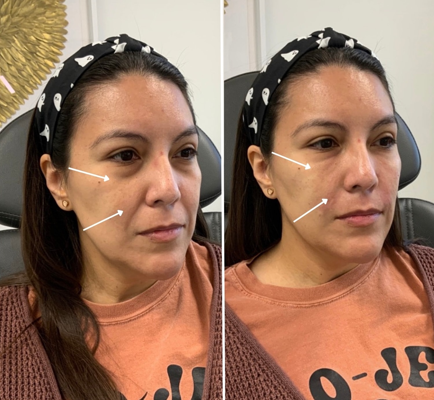 PRF Gallery Before & After