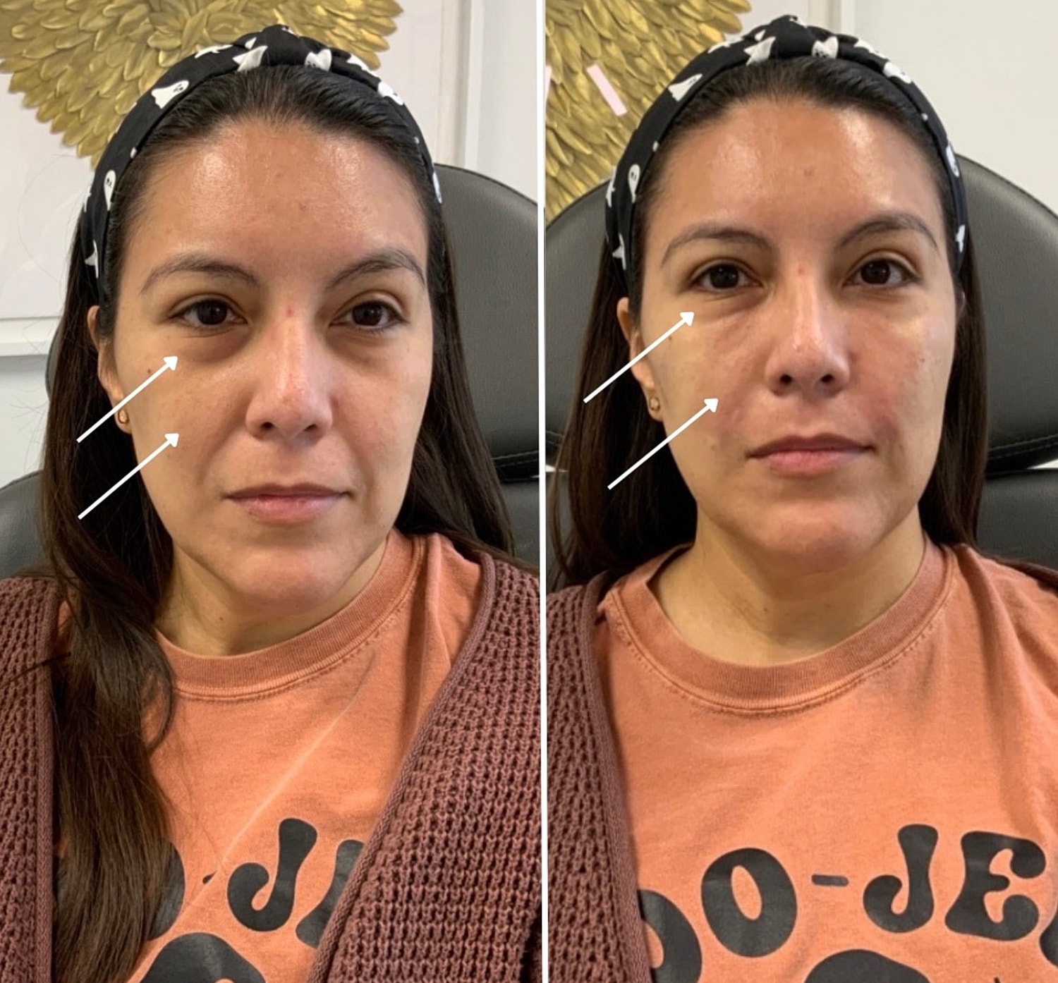 PRF Gallery Before & After